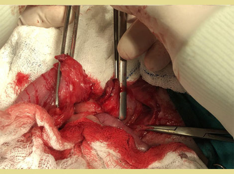 Η χρήση της προσωρινής κολοστομίας The use of temporary colostomy