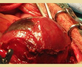 The gallbladder mucocele in dogs