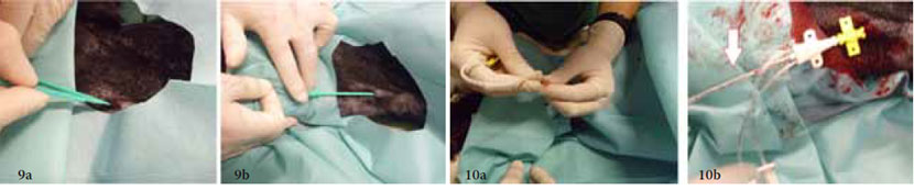 Jugular vein catheter placement Indications & technique