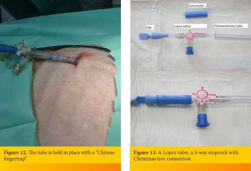Thoracostomy tube placement