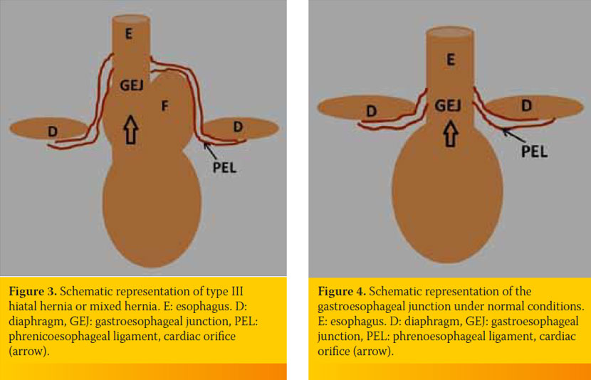 Current views regarding hiatal hernia in dogs and cats