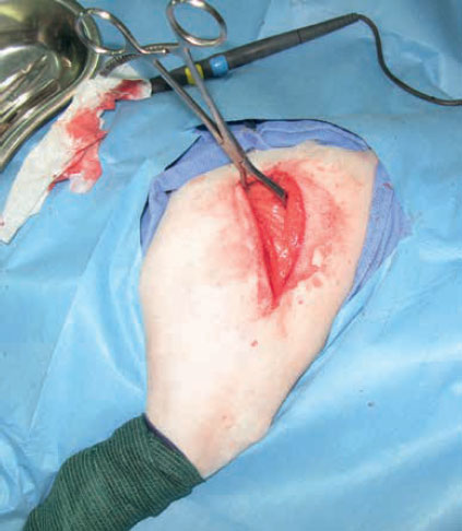 v8i2 femoral head excision img6