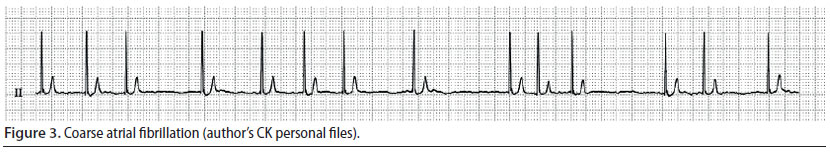 v8i2 perioperative cardiac arrhythmias img3 en