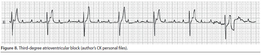 v8i2 perioperative cardiac arrhythmias img8 en